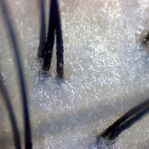 髪のお悩み解決しましょう。「抜け毛予防」